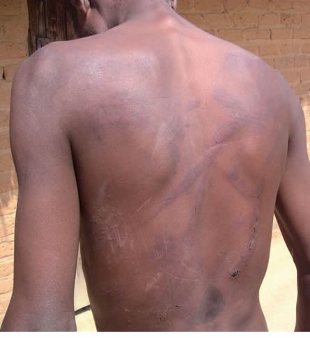 MDC official's back, scarred from beating in post-election violence