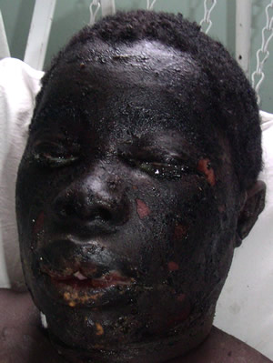 Face burnt by petrol bomb